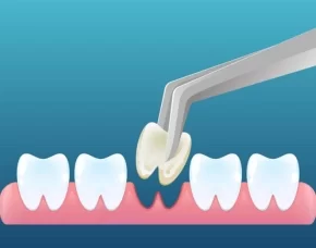 Extraction Extraction