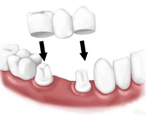 Crown-Bridge Crown-Bridge